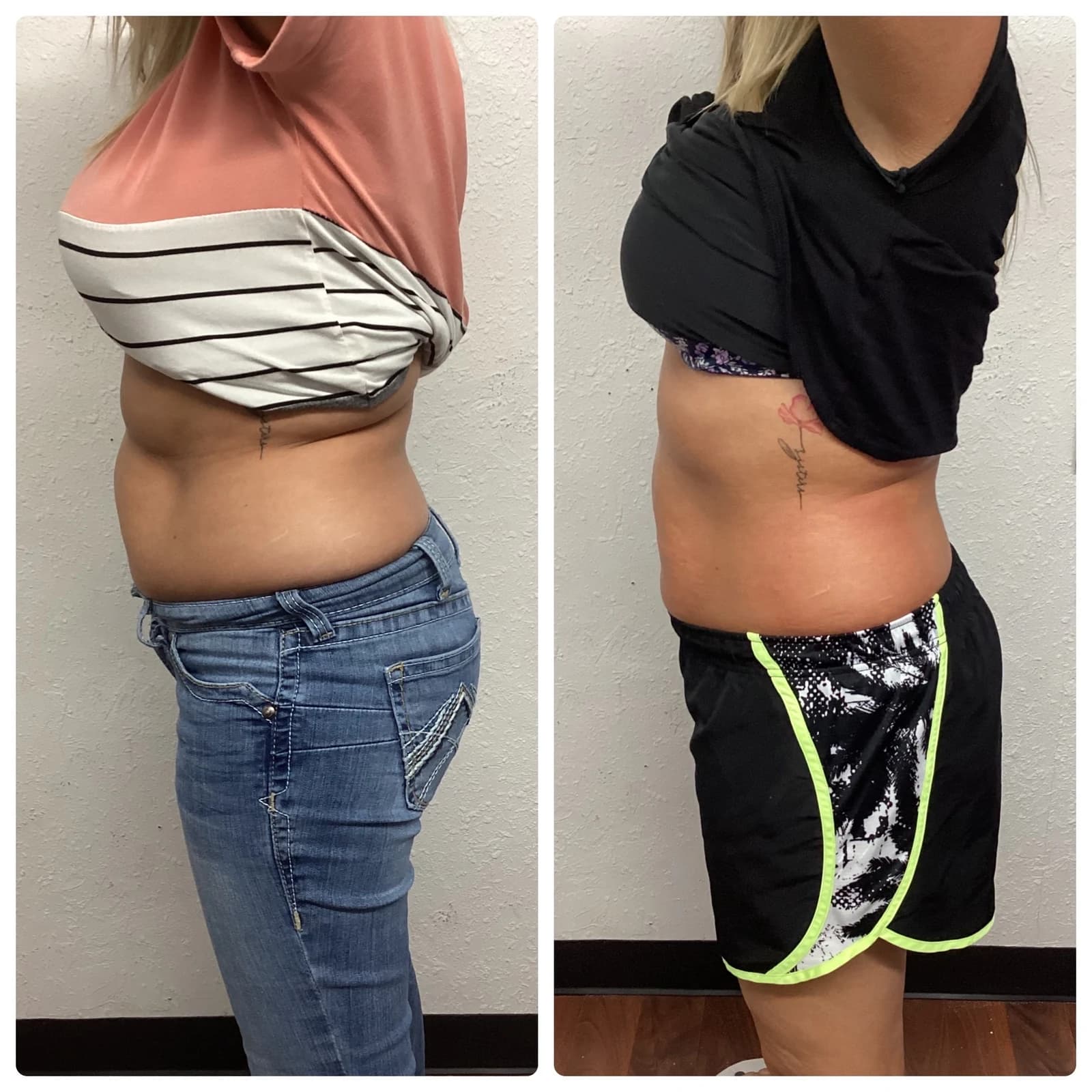 Cryoskin slimming before-and-after side waist result supplied by SK Longevity.
