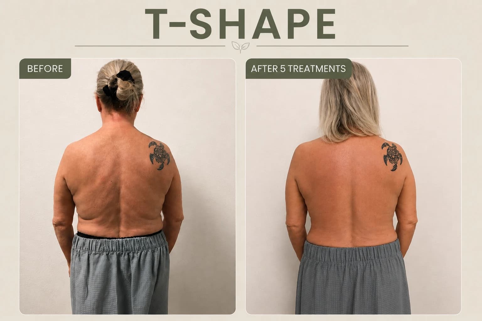 T-Shape before-and-after back view supplied by SK Longevity after five treatments.
