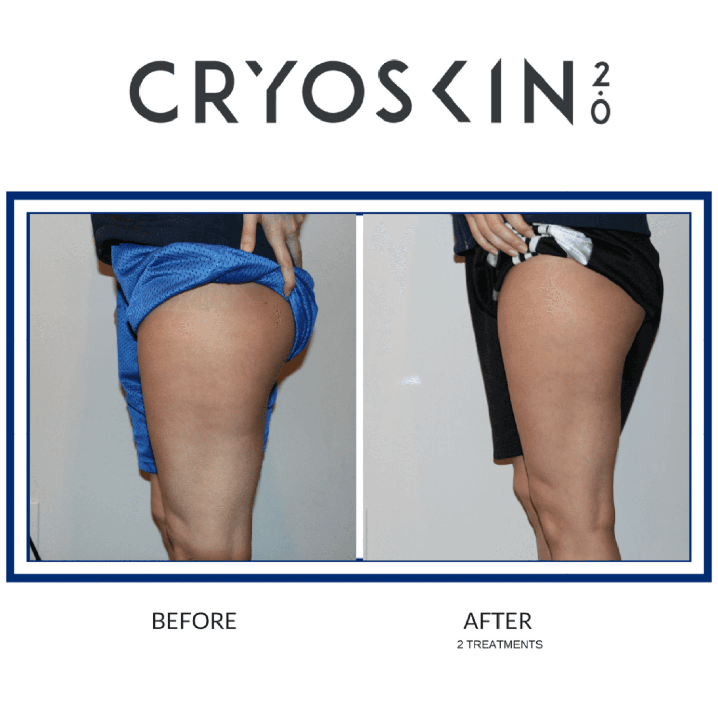 SK Longevity Cryoskin before-and-after leg contouring result.