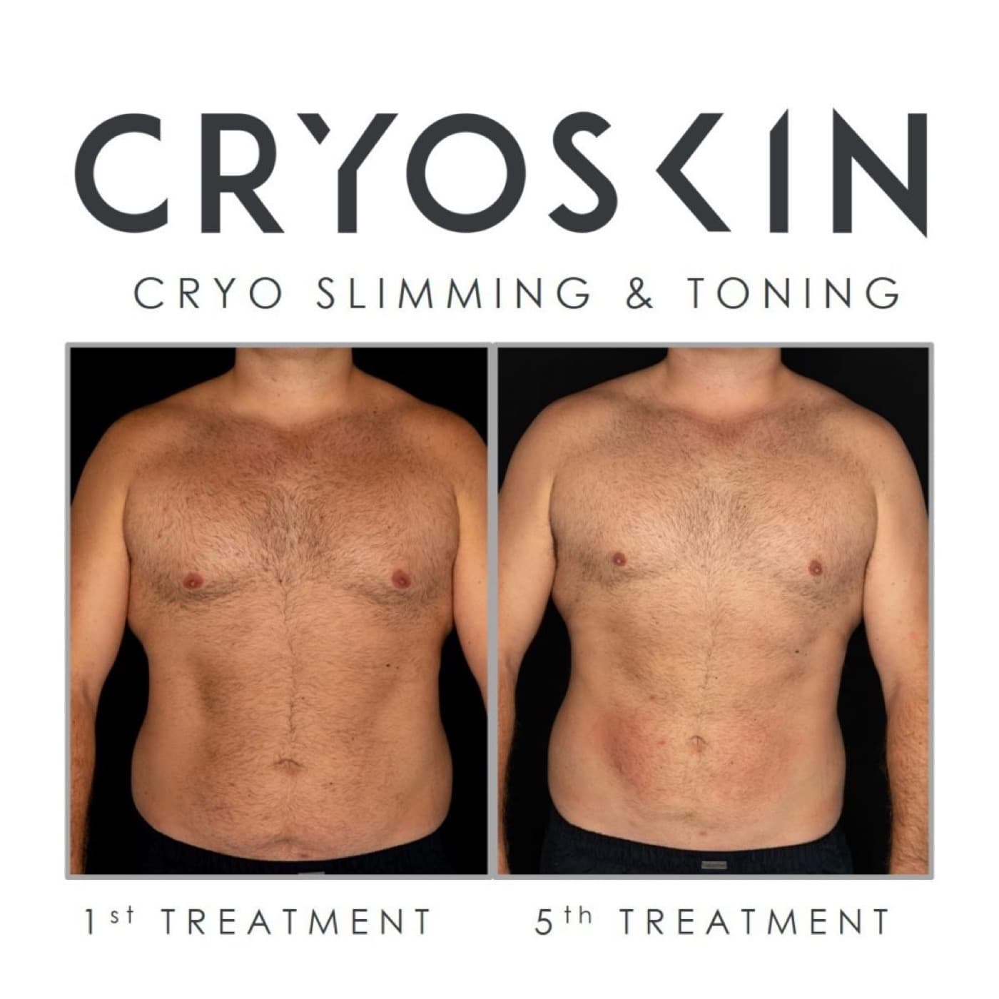 SK Longevity Cryoskin before-and-after torso contouring result.